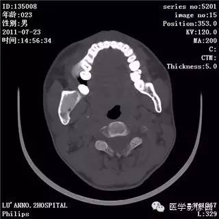 【病例】颅骨骨纤维异常增殖症1例CT影像表现 【病例】颅骨骨纤维异常增殖症1例CT影像表现