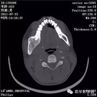 【病例】颅骨骨纤维异常增殖症1例CT影像表现 【病例】颅骨骨纤维异常增殖症1例CT影像表现