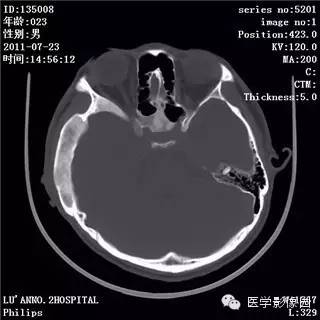 【病例】颅骨骨纤维异常增殖症1例CT影像表现 【病例】颅骨骨纤维异常增殖症1例CT影像表现