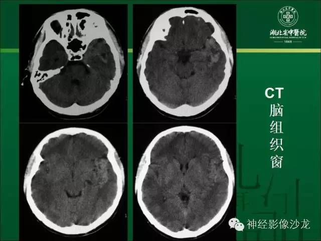 【病例】左颞叶脑动静脉畸形1例CT及MR影像表现