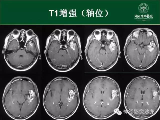 【病例】左颞叶脑动静脉畸形1例CT及MR影像表现