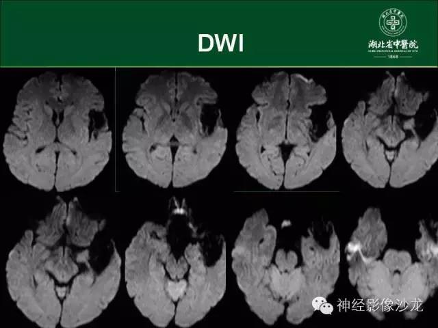 【病例】左颞叶脑动静脉畸形1例CT及MR影像表现
