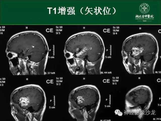 【病例】左颞叶脑动静脉畸形1例CT及MR影像表现