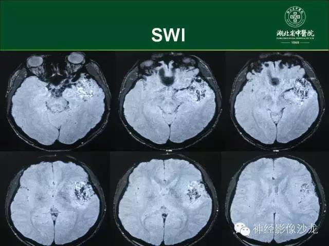 【病例】左颞叶脑动静脉畸形1例CT及MR影像表现