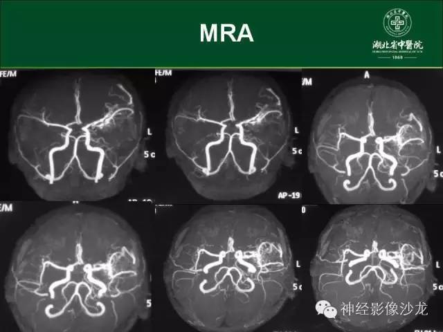 【病例】左颞叶脑动静脉畸形1例CT及MR影像表现