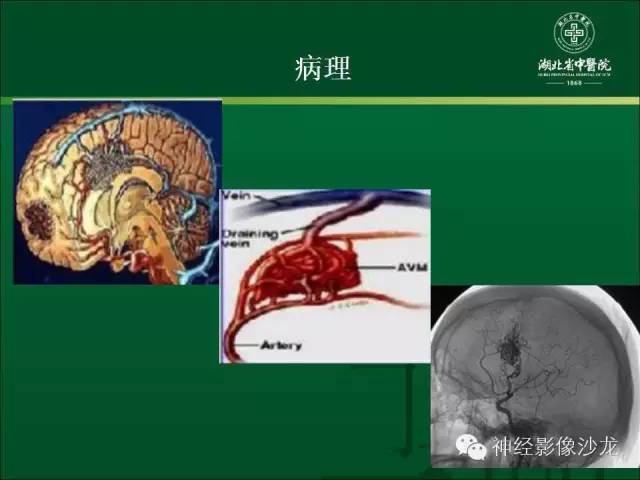 【病例】左颞叶脑动静脉畸形1例CT及MR影像表现