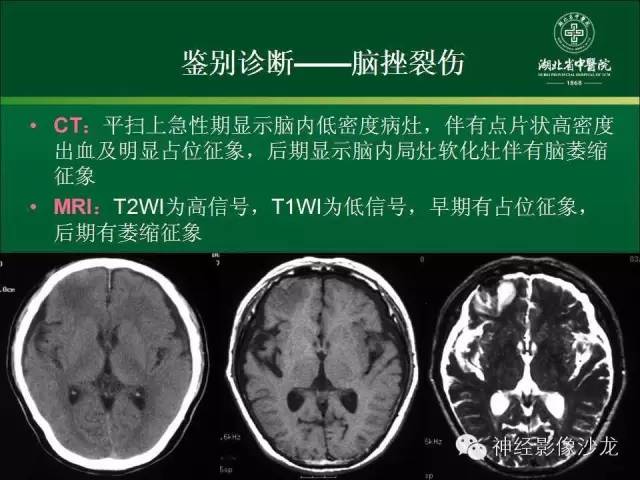【病例】左颞叶脑动静脉畸形1例CT及MR影像表现
