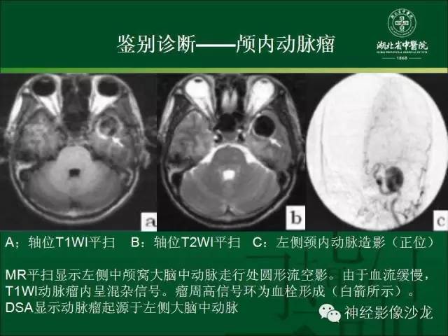 【病例】左颞叶脑动静脉畸形1例CT及MR影像表现