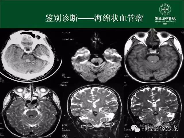 【病例】左颞叶脑动静脉畸形1例CT及MR影像表现