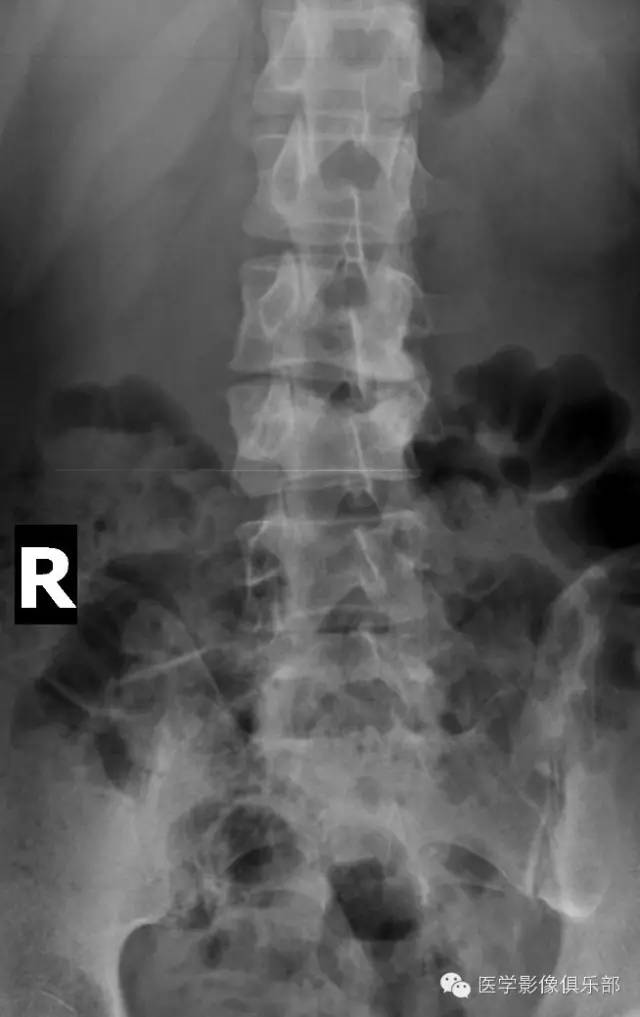 【病例】腰椎结核1例CT影像表现