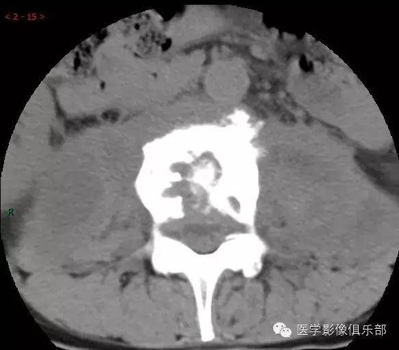【病例】腰椎结核1例CT影像表现 【病例】腰椎结核1例CT影像表现