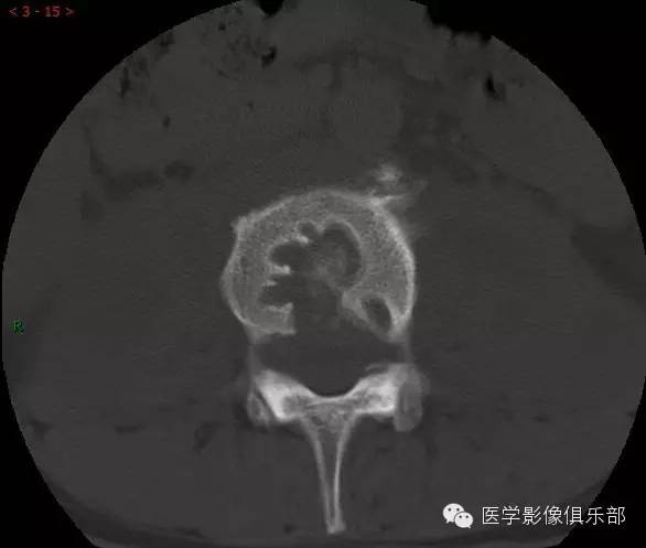 【病例】腰椎结核1例CT影像表现 【病例】腰椎结核1例CT影像表现