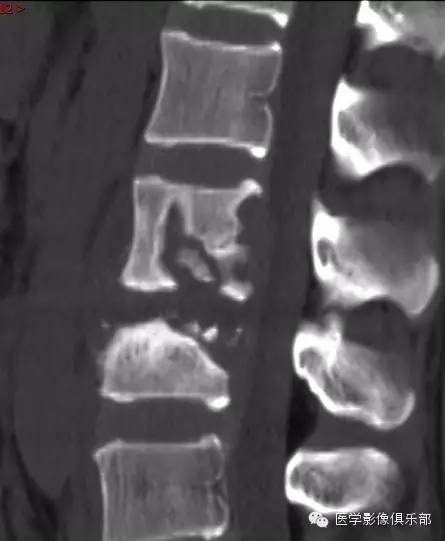 【病例】腰椎结核1例CT影像表现 【病例】腰椎结核1例CT影像表现