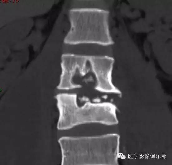 【病例】腰椎结核1例CT影像表现 【病例】腰椎结核1例CT影像表现