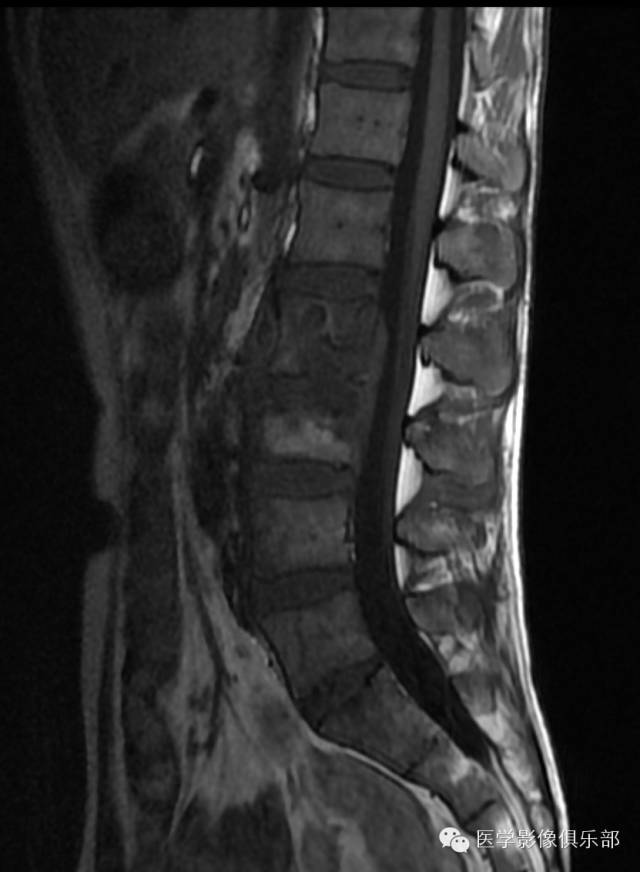 【病例】腰椎结核1例CT影像表现 【病例】腰椎结核1例CT影像表现