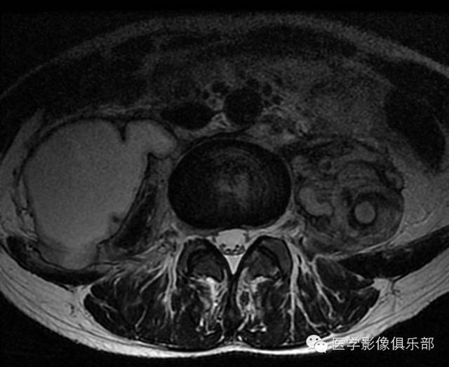 【病例】腰椎结核1例CT影像表现 【病例】腰椎结核1例CT影像表现