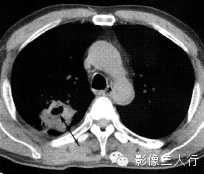 肺空洞性病变的鉴别诊断 肺空洞性病变的鉴别诊断