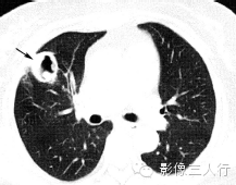 肺空洞性病变的鉴别诊断 肺空洞性病变的鉴别诊断