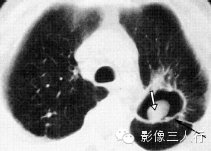 肺空洞性病变的鉴别诊断 肺空洞性病变的鉴别诊断