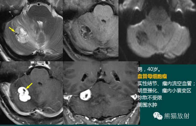 小脑半球的肿瘤MRI表现 小脑半球的肿瘤MRI表现