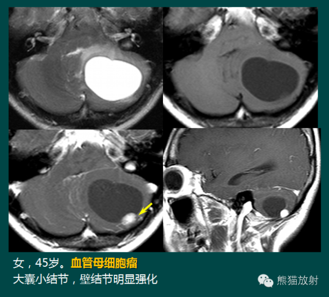 小脑半球的肿瘤MRI表现 小脑半球的肿瘤MRI表现