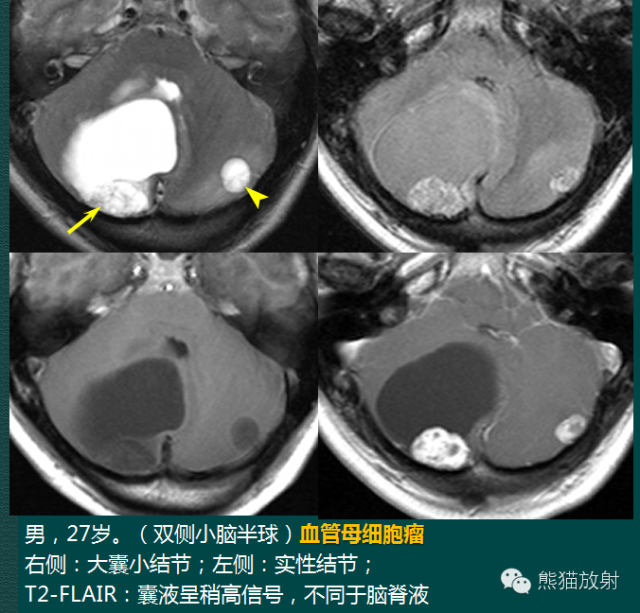 小脑半球的肿瘤MRI表现 小脑半球的肿瘤MRI表现
