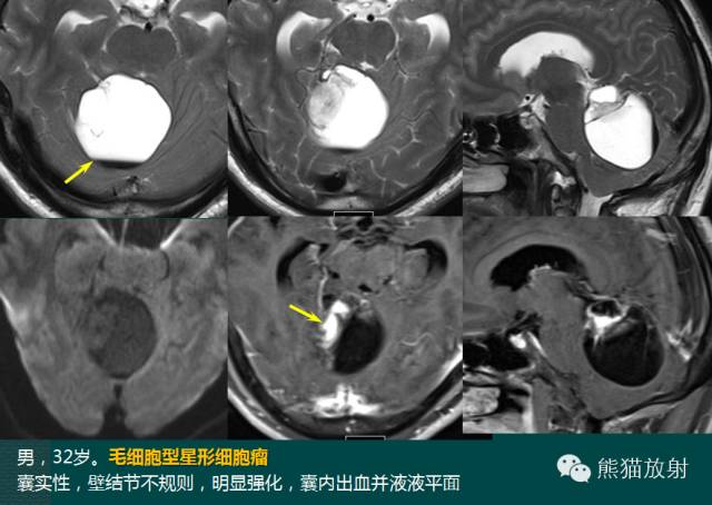小脑半球的肿瘤MRI表现 小脑半球的肿瘤MRI表现