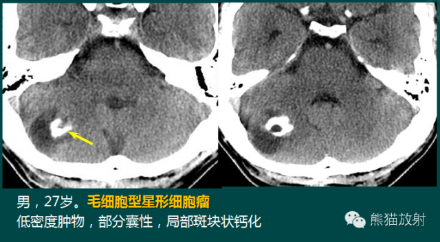 小脑半球的肿瘤MRI表现 小脑半球的肿瘤MRI表现