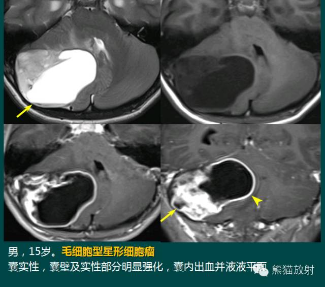 小脑半球的肿瘤MRI表现 小脑半球的肿瘤MRI表现