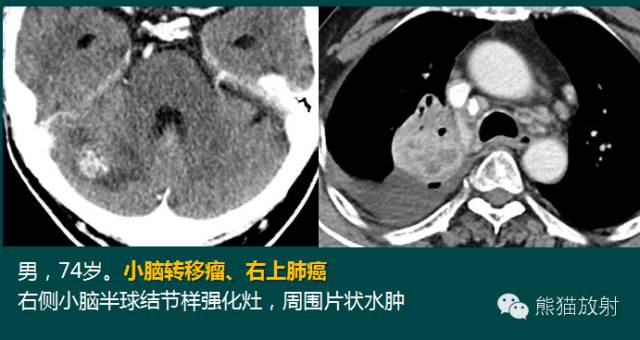 小脑半球的肿瘤MRI表现 小脑半球的肿瘤MRI表现