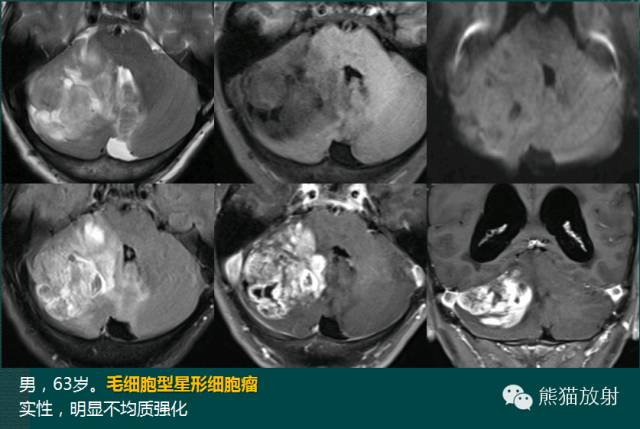 小脑半球的肿瘤MRI表现 小脑半球的肿瘤MRI表现