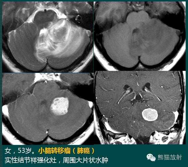 小脑半球的肿瘤MRI表现 小脑半球的肿瘤MRI表现