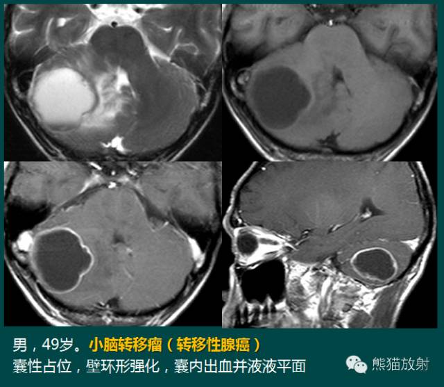 小脑半球的肿瘤MRI表现 小脑半球的肿瘤MRI表现