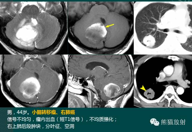 小脑半球的肿瘤MRI表现 小脑半球的肿瘤MRI表现