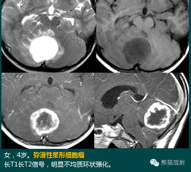 小脑半球的肿瘤MRI表现 小脑半球的肿瘤MRI表现