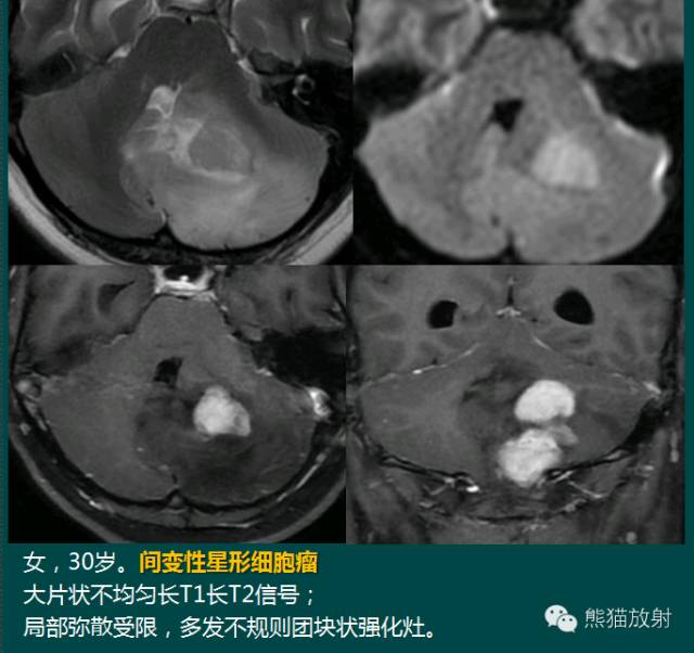 小脑半球的肿瘤MRI表现 小脑半球的肿瘤MRI表现