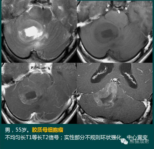 小脑半球的肿瘤MRI表现 小脑半球的肿瘤MRI表现