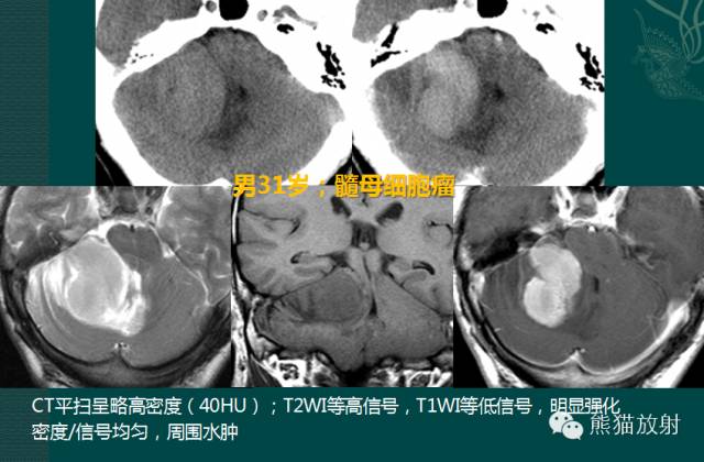 小脑半球的肿瘤MRI表现 小脑半球的肿瘤MRI表现