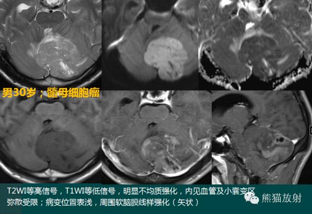 小脑半球的肿瘤MRI表现 小脑半球的肿瘤MRI表现