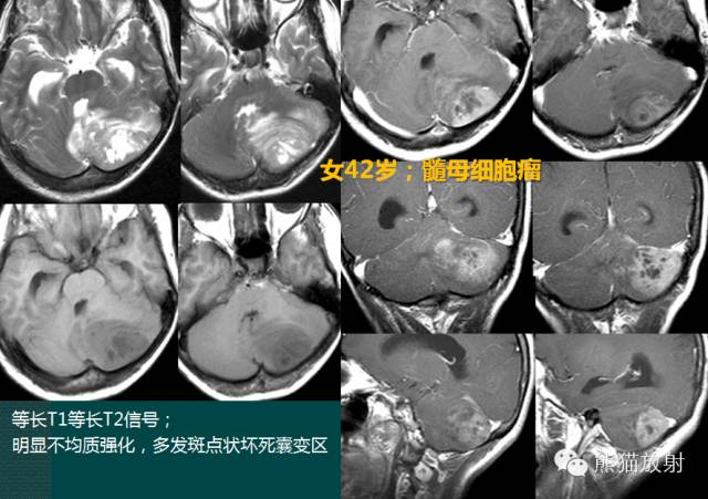小脑半球的肿瘤MRI表现 小脑半球的肿瘤MRI表现
