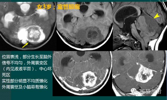 小脑半球的肿瘤MRI表现 小脑半球的肿瘤MRI表现