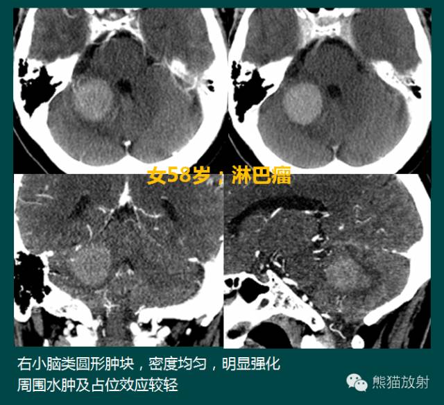 小脑半球的肿瘤MRI表现 小脑半球的肿瘤MRI表现