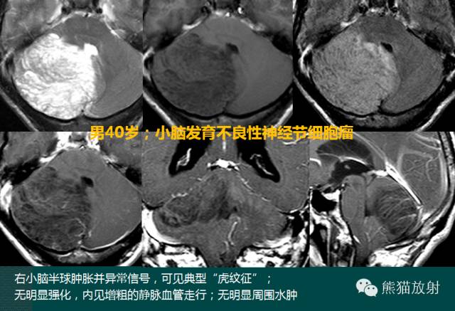 小脑半球的肿瘤MRI表现 小脑半球的肿瘤MRI表现
