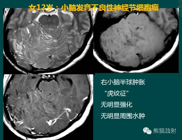 小脑半球的肿瘤MRI表现 小脑半球的肿瘤MRI表现