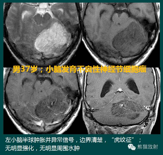 小脑半球的肿瘤MRI表现 小脑半球的肿瘤MRI表现