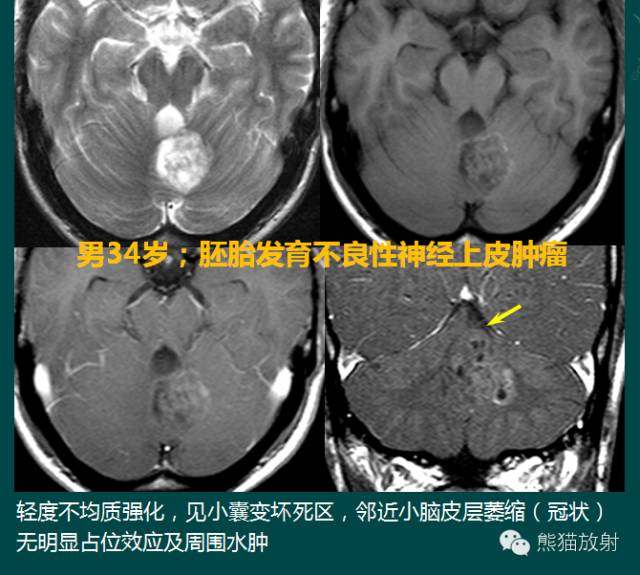 小脑半球的肿瘤MRI表现 小脑半球的肿瘤MRI表现
