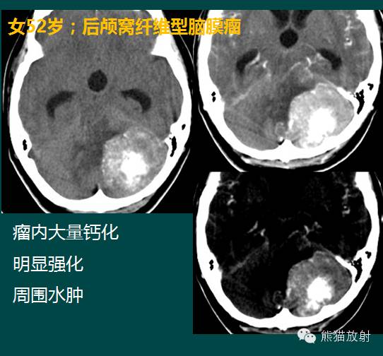 小脑半球的肿瘤MRI表现 小脑半球的肿瘤MRI表现