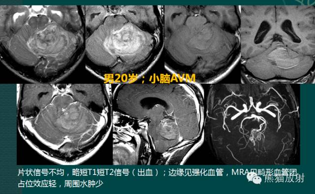 小脑半球的肿瘤MRI表现 小脑半球的肿瘤MRI表现