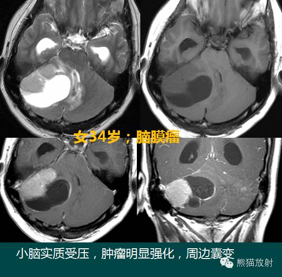 小脑半球的肿瘤MRI表现 小脑半球的肿瘤MRI表现