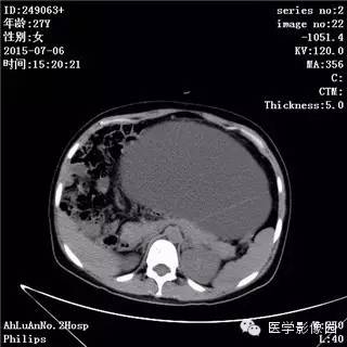 【病例】卵巢粘液性囊腺瘤1例CT影像表现 【病例】卵巢粘液性囊腺瘤1例CT影像表现